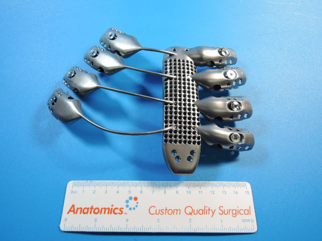 Titanium implant encompassing part of a sternum and ribcage created through additive manufacturing. Courtesy of Anatomics.
